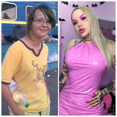 Emma Hix before and after surgery : r/beforevsafter